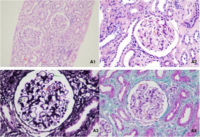 Systemic lupus erythematosus complicated with Fanconi syndrome: a case report and literature review